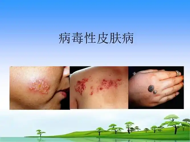 病毒性皮肤病86130