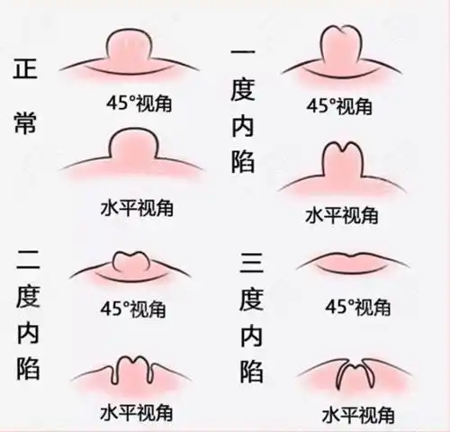 乳房长"酒窝"?医生:警惕乳腺癌,乳腺癌的4大误区