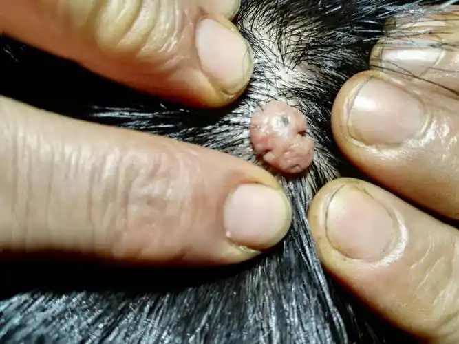 这个肉疙瘩是老爸头上长出来的,差不多有十几年了.不疼不痒的.