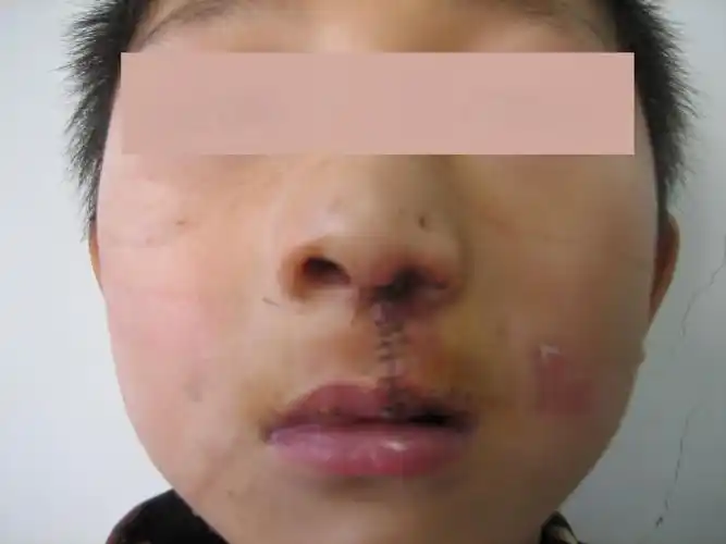 唇裂术后畸形二期手术修复 - 好大夫在线