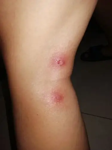 腿部起红包,好几天了都不好