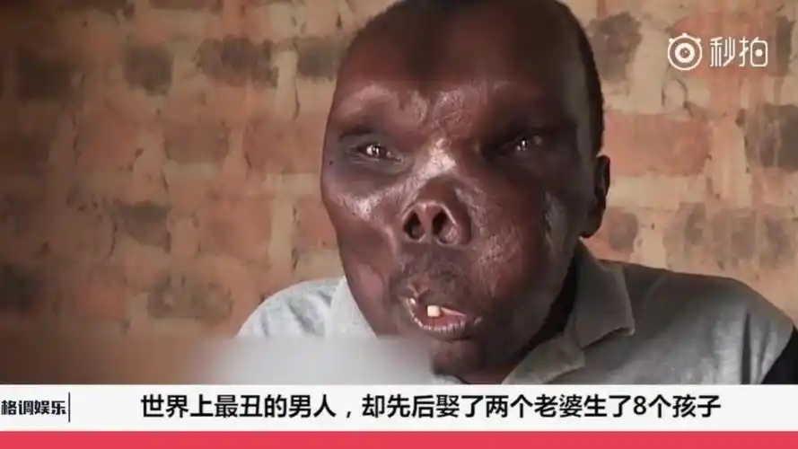 当年那个世界上最丑的男人现在过得怎么样了网友人生赢家