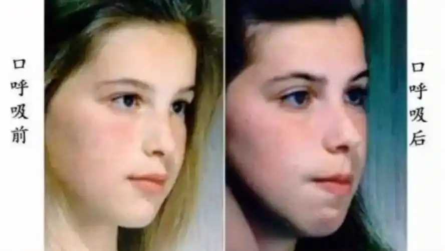 腺样体面容,面部一旦形成,就没办法调整了,看看你身边是否有很多,这种