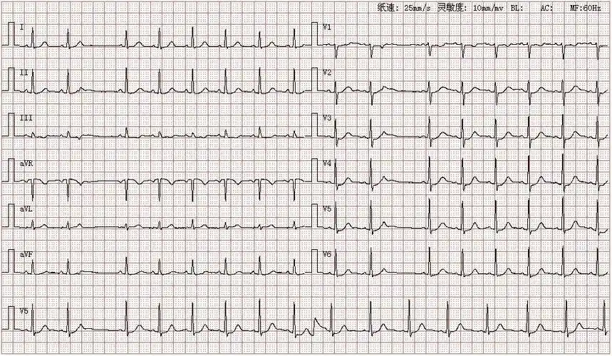 心电图图库丨房性早搏系列
