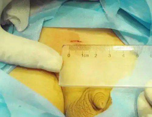 疝气微创手术能报销吗 学生医保疝气