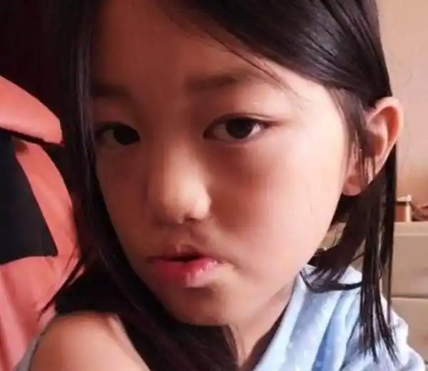 也有例外的,就比如王菲和李亚鹏的女儿李嫣,李嫣是先天性的唇腭裂,看