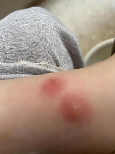 (更)被虫子咬的两个大包