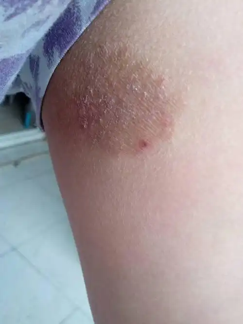 我这大腿内侧长了一块灰褐色的小斑,有时候很痒,问一下是长的个什么