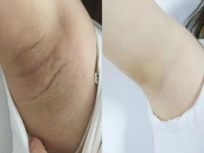 腋毛拔除后腋下大面积发黑怎么办? - 知乎
