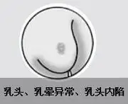 乳腺癌的常见症状有哪些?专家权威为您解析