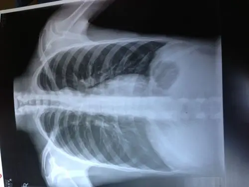 刚刚医院照的x光,有什么问题吗, 右上方那个圆形阴影是啥?