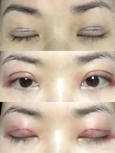 全切双眼皮的第五个月,恢复超级自然啊