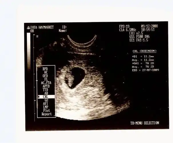 教你孕囊看男女不是不准是你不会看只图个乐子