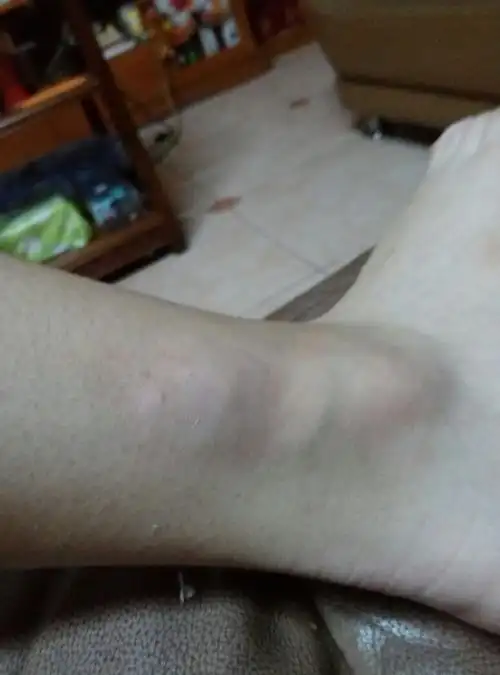 我的脚肿了好大一块 有点刺痛 是不是骨折了?