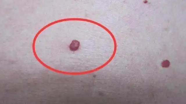 这其实是一种皮肤血管瘤,也叫做樱桃样血管瘤,老百姓又叫做朱砂痣