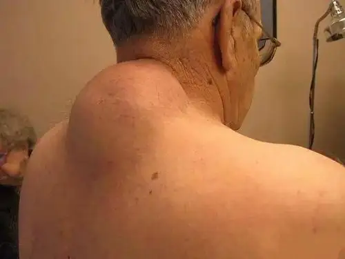 脂肪瘤需要手术切除吗