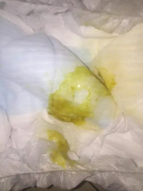 宝宝这是不是拉肚子了,我想问的是怎么稀得有点像女人的白带一样那种