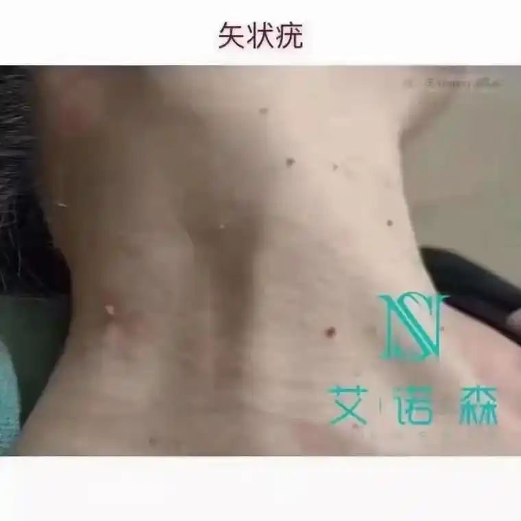 99疣的病发原因 959595 中医认为:这种疾病系阴血不足 - 抖音