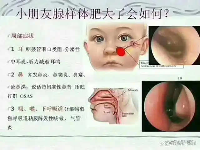腺样体知识科普:孩子得了腺样体肥大后,医院手术是怎么切除的?
