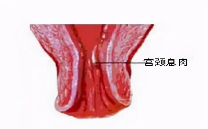 4宫颈息肉:更年期女性尽早摘除建议:胆囊息肉直径>1厘米,尤其是年龄50