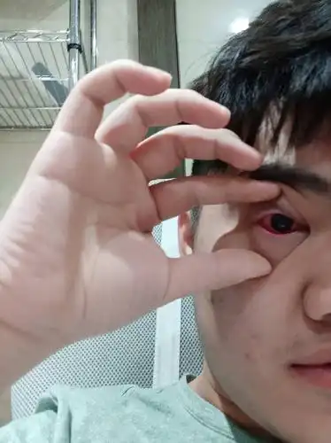 眼睛红肿一直流泪