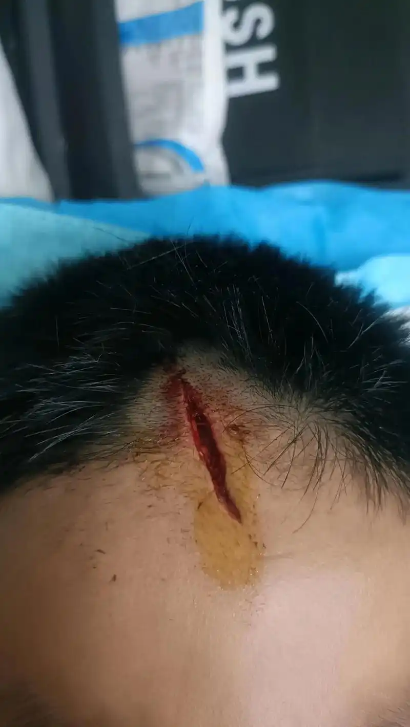 儿子磕破头12天一直不能沾水,用湿布擦了擦头发,恢复成这样也算可以