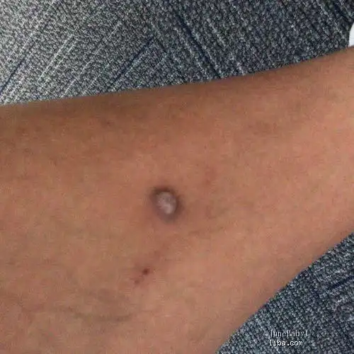 腿上长纤维瘤要割掉哪个医院好就附近找个三甲可以吗