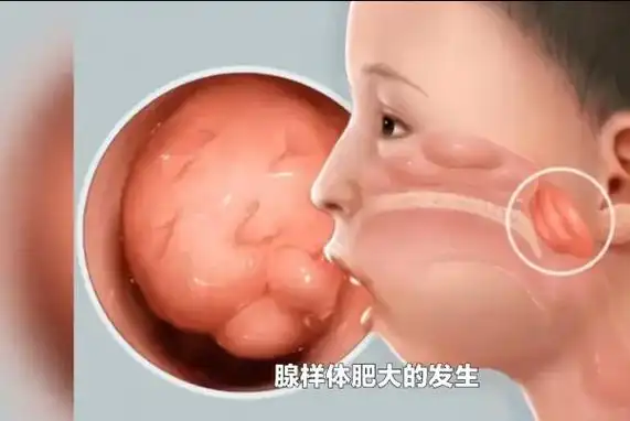 医学小知识   1.首先是腺样体面容:由于长期张口呼吸,致 - 抖音