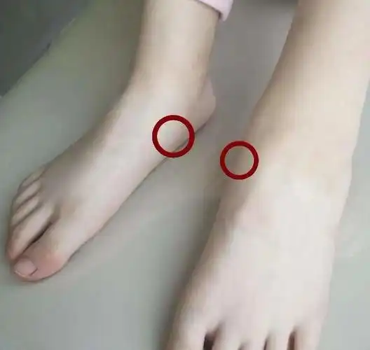 儿童足部副舟骨的治疗_先天性足畸形_先天性足畸形治疗方式 - 好大夫