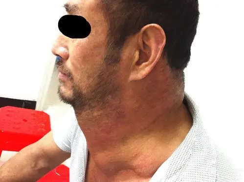 颈部多发性脂肪瘤 [病例帖]