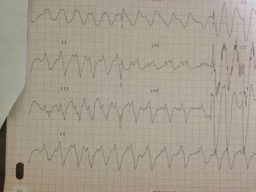 心电图分析室速