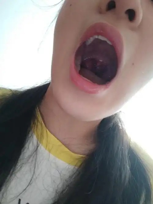 扁桃体发炎成这样,要什么要三天能好?