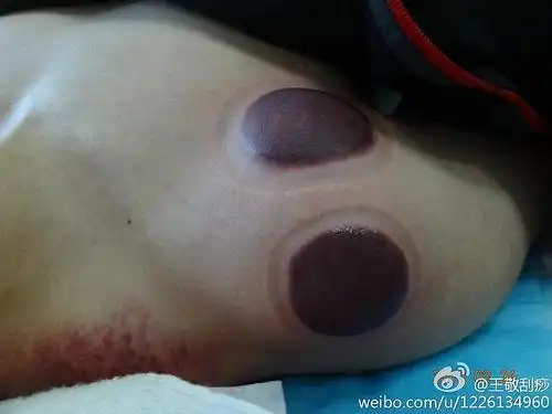 一位从国外赶在看病的病人肩部出痧图,大家看看黑色的痧