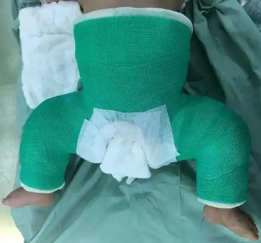 宝宝发育性髋关节脱位不尽早治疗,可影响孩子的行走功能