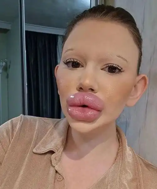 女子痴迷丰唇成为全球嘴唇最厚网红,拍卖自己的厚唇热吻_腾讯新闻