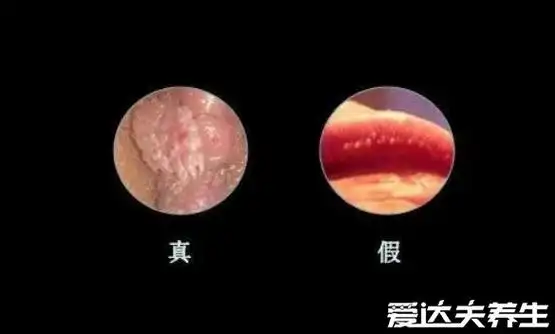 男性尖锐湿尤图初期图片,为菜花样小疙瘩会相互融合