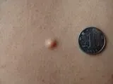 身上长了个小脂肪瘤