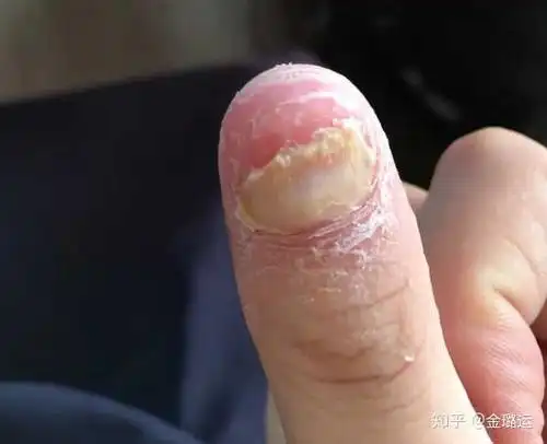 请问这个是灰指甲吗