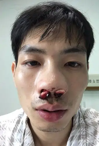 怎样才能永久摆脱过敏性鼻炎?