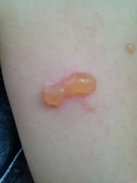 这几天不知道怎么回事,胳膊无缘无故长了个水泡,是被虫子咬,还是皮肤