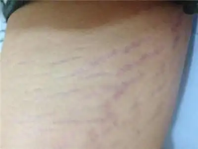 紫纹怎么消除了解种类快速解决