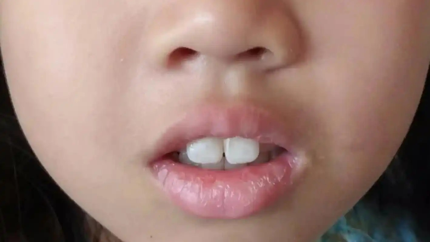 我们发现,腺样体肥大的孩子,学习成绩总比别人差,这是什么原因呢?