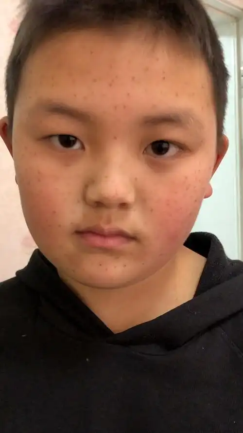 天生的雀斑让儿子感觉很自卑,多亏闺蜜的介绍,斑点没了,在也不会受小