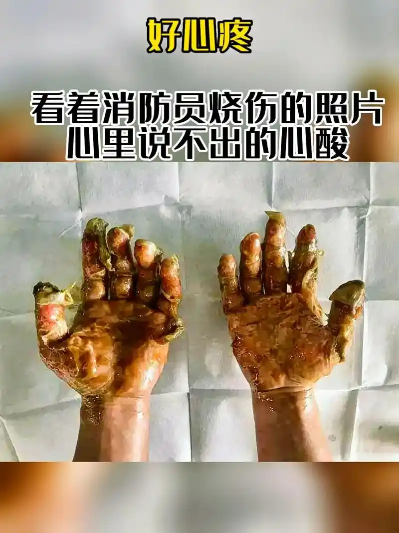 看着这一张张消防员灭火后烧伤的照片心里说不出的难受,好心疼!