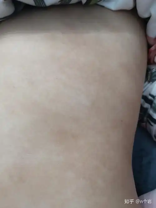 肚子上这个是汗斑么? - 知乎