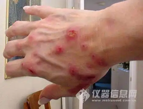 主题:【事件聚焦】揭秘蜱虫"咬人门"事件,彰显生命的脆弱!