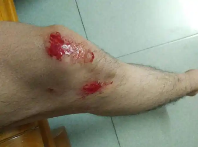 伤口我该怎么处理?(有点儿疼)