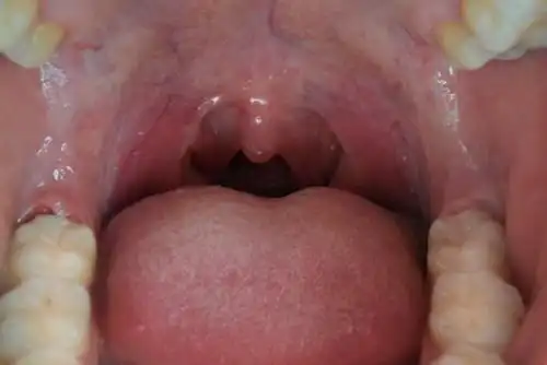 口腔右边最里面的牙龈不知道是肿了,还是怎么回事多了一块肉还跟牙齿