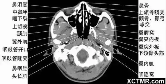 ct轴位鼻腔和鼻窦层面(中鼻甲水平) - 解剖图片ct轴位鼻腔和鼻窦层面