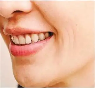 该如何抹平嘴角纹